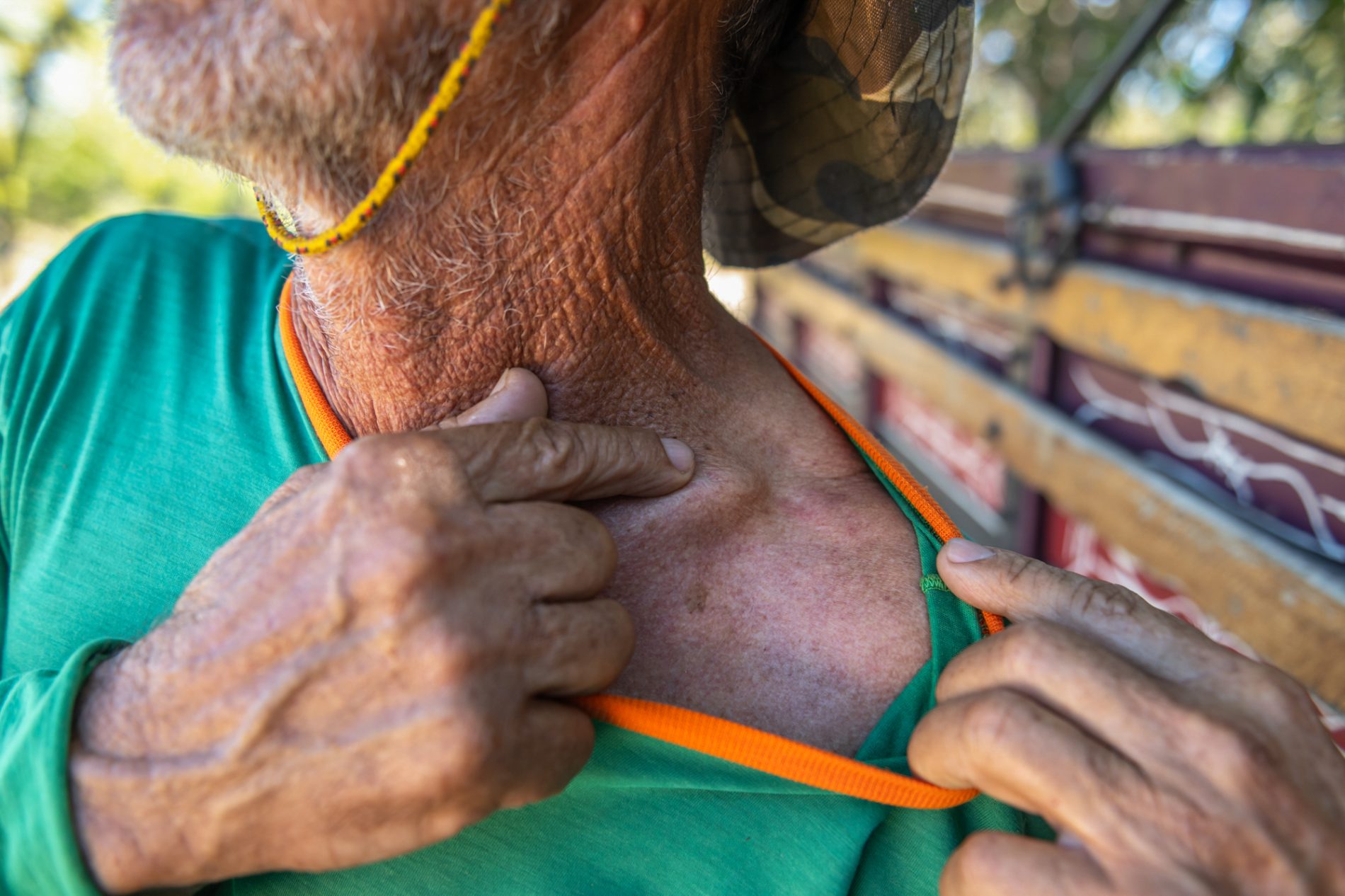 Close-up de um homem mais velho usando camiseta verde e chapéu camuflado, puxando a gola da camisa com uma das mãos e apontando com o dedo para a região da clavícula, sob a luz do sol. A pele mostra sinais de envelhecimento e exposição ao sol.