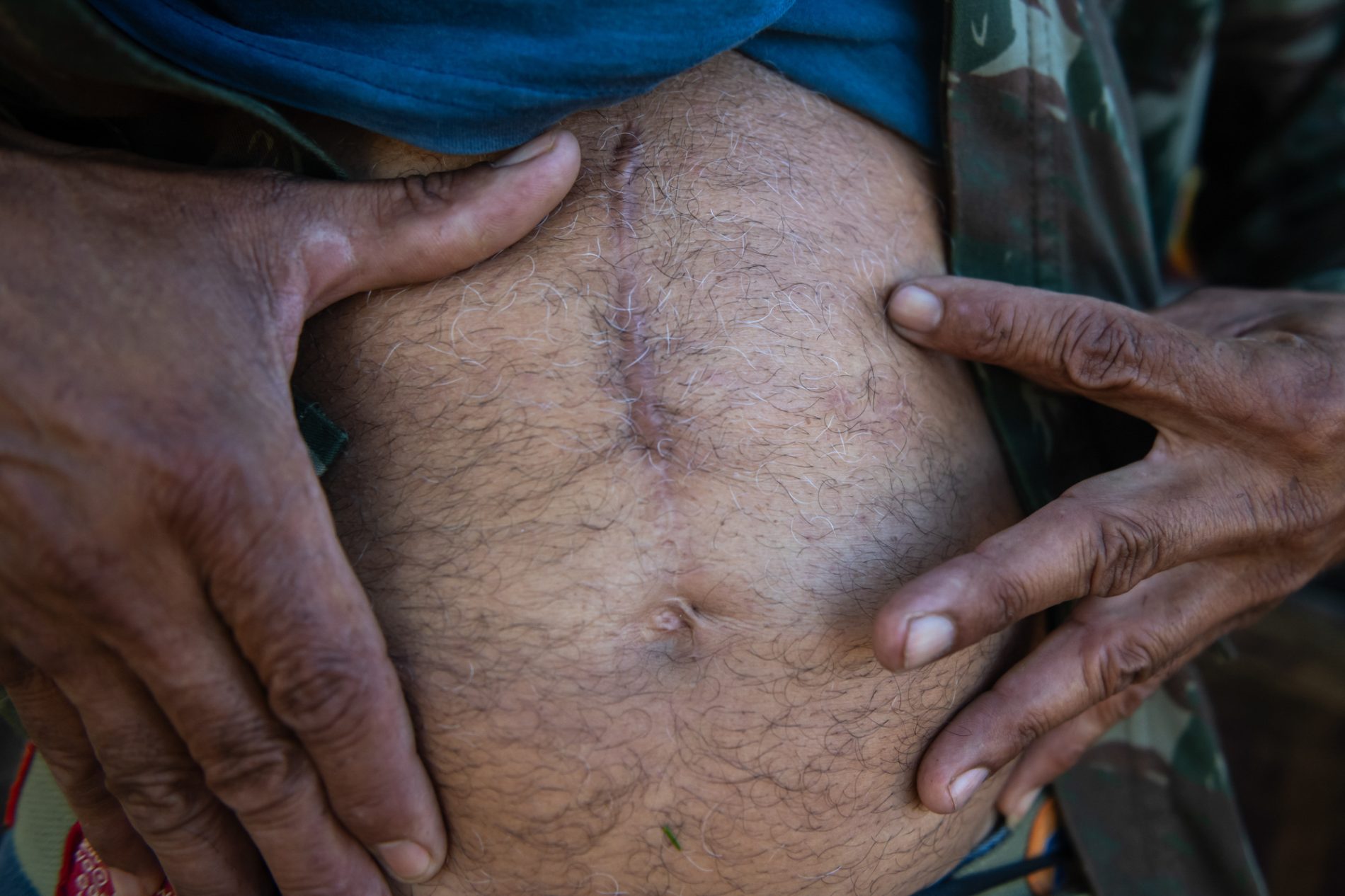 Close-up de um abdômen masculino com pele morena e pelos brancos, onde se destaca uma cicatriz vertical proeminente. As mãos do homem puxam a roupa para revelar a marca, sugerindo uma cirurgia passada.